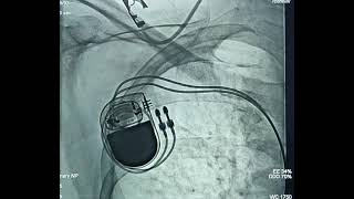 Dual chamber pacemaker implantation [upl. by Cronin763]