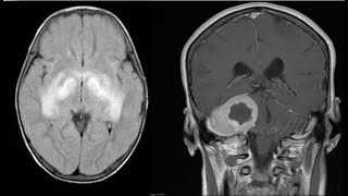 15CNSneuroradiologySpotterscasesradiopediaMRICTXrayangiographyquizzesfrcrexamsbesttip [upl. by Cantlon]