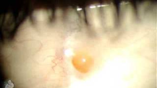 Pyogenic Granuloma on Eye [upl. by Ahsit]