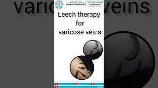 Leach therapy for varicose veins leachtherapyleachtreatmentvericoseveinsdranujtyagi [upl. by Len]