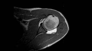 Labral tear in 20 year old [upl. by Dranoc]