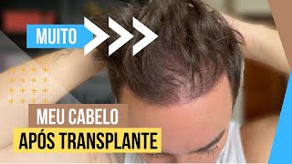 RESULTADO TRANSPLANTE CAPILAR  VITAMINAS QUE EU USO [upl. by Sachs]