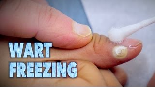 FREEZING WARTS With Sizzling Liquid Nitrogen  Dr Paul [upl. by Coheman72]