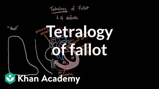 Tetralogy of fallot  Circulatory System and Disease  NCLEXRN  Khan Academy [upl. by Lulita]