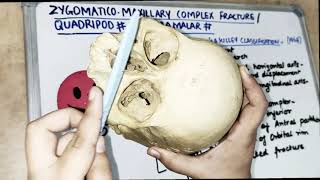 zmc zygomatic complex fracture lecture  classification [upl. by Agnew97]