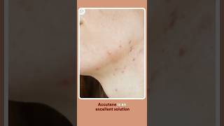 Accutane amp Skincare Essential Tips for Treating Acne [upl. by Reh489]