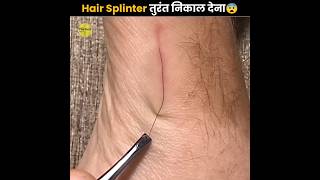 Remove Hair Splinter Immediately⚠️ [upl. by Nonnahsal515]