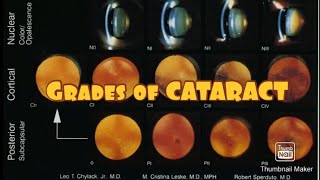 Grades of CATARACT 👀 [upl. by Annahvas]