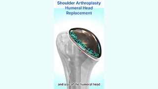 Shoulder Hemiarthroplasty  Humeral head replacement [upl. by Theurer16]