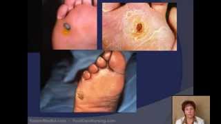 Corn amp Callus Debridement by a Podiatrist [upl. by Ardnikat]