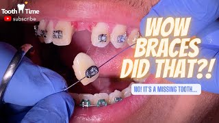 Braces with a missing tooth  video 3  Tooth Time Family Dentistry New Braunfels Texas [upl. by Alvie878]