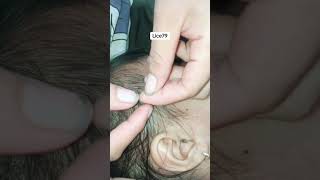 banyak Kuto lice satisfying removal relaxing [upl. by Ecnerrat]