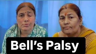 Bell’s Palsy Patient Review Recovery Dr Pritam Singh  Jigars physiotherapist [upl. by Simah111]