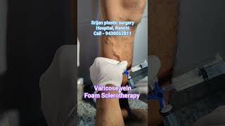 Foam Sclerotherapy Treatment for varicose veins Varicose veins treatment in Ranchi shorts veins [upl. by Arul592]