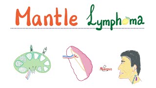 Mantle Cell Lymphoma  Aggressive BCell Neoplasm  NonHodgkin’s Lymphoma NHL  Hematology [upl. by Ailimaj]