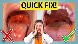 Strep Throat  treat it fast learn how [upl. by Owena]