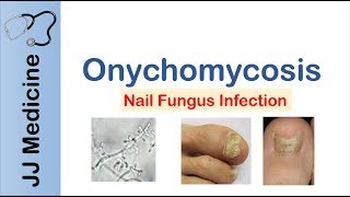 Onychomycosis  Nail Infection  Signs Symptoms Treatment [upl. by Verile]