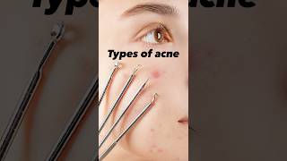 Types of acne acneskincarebeauty acneproneskin [upl. by Nilek]