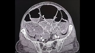 Colonic  large bowel tumour causing obstruction CT findings [upl. by Ggerg]