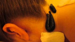 Holistic Therapy  Leeches Treatment Dublin  Ireland  Headache  migraine [upl. by Retsam]