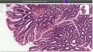 Traditional Serrated Adenoma  Histopathology [upl. by Auqined174]