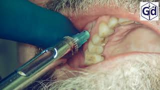 Infiltration Anesthesia for treatment tooth 24 [upl. by Nwadal]