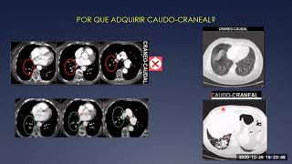 12 Angio TC de las Arterias Pulmonares evidencia actual bajo kilovoltaje y baja dosis de contraste [upl. by Ytok]