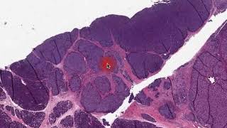 Digital Surgical Pathology pancreas Acinar Carcinoma [upl. by Mauralia]