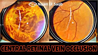 Central Retinal Vein Occlusion CRVO [upl. by Parfitt159]