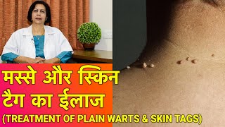 प्लेन Warts और स्किन टेग का ईलाज  Treatment of Plain Warts amp Skin Tags [upl. by Deach]