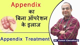 Best treatment of Appendix without operation  Appendicitis Best Treatment  अपेंडिक्स का इलाज [upl. by Demmahum]