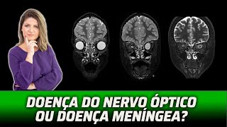 NERVOS ÓPTICOS MUITO ALÉM DA NEURITE ÓPTICA [upl. by Ahsikram327]