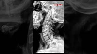 C spine radiologyct4519 manhjik181 spinecentralxray7034 medicalctscanmrixrays1688 [upl. by Ness]