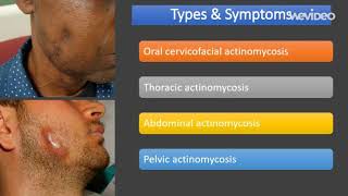 actinomycosis  Introduction Types Symptoms [upl. by Ibbison109]