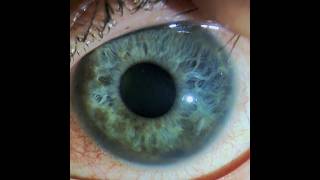 Uncontrolled IOP in an Eye with a Ciliary Body Melanoma 4 Months after Brachytherapy [upl. by Sibbie]