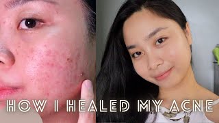 How I healed my acne  Paano nawala ang pimples ko  Arvie Ramos [upl. by Aipmylo]