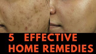 5 EFFECTIVE Home Remedies for Skin Pigmentation Brown Spots and freckles [upl. by Grannias]