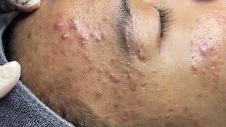 ACNE TREATMENT VU QUYNH MI  Perennial Blackheads On Boy Face 2024FULL [upl. by Asinet859]