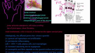 93P What is Rheumatoid Arthritis RA morphology prevalence pannus Rheumatoid nodules [upl. by Norab261]