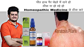 Keratosis Pilaris  पीठ और चेहरे में छोटेछोटे दाने  Homeopathic Medicine  Cause  How to use [upl. by Ydisahc960]