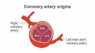 How to find the coronary artery origins using CT [upl. by Rigby]