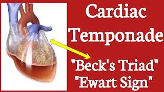 Cardiac Temponade  Becks Triad  Pulsus Paradoxus  Ewart Sign [upl. by Ketchan295]