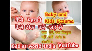 Atopic dermatitis Eczemain kids  reason and treatment बच्चों में एक्जिमा और त्वचा की देखभाल [upl. by Hctim167]