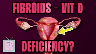 Is Vitamin D a Fibroid Cure [upl. by Aceissej]