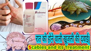 scabies treatment scabies rash how to get rid of scabies  scaboma lotion [upl. by Gnolb]