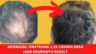 Best hair regrowth hair medicine for male [upl. by Solahcin]