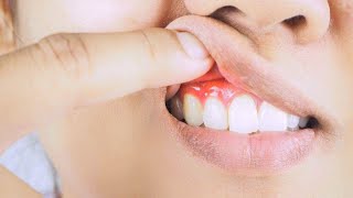 ACUPUNCTURE FOR INFLAMED GUMS GINGIVITIS [upl. by Fazeli]