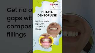 Get rid of Teeth Gaps with Composite Fillings Dr Srishti Bhatia confidentsmile healthysmile [upl. by Ecirp]