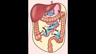 Internal hernia  small bowel obstruction CT findings [upl. by Yknip]