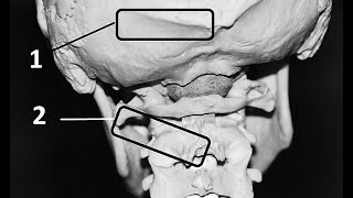 What is Occiptial Neuralgia [upl. by Heffron]